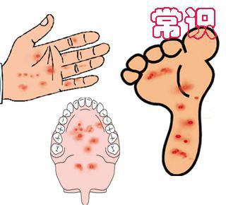 手足病是如何预防.png